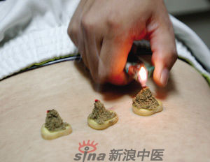 灸法的種類  你知道多少？